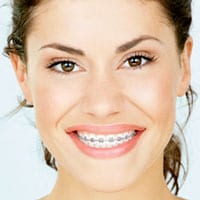 Cost of Braces - Invisalign Costs